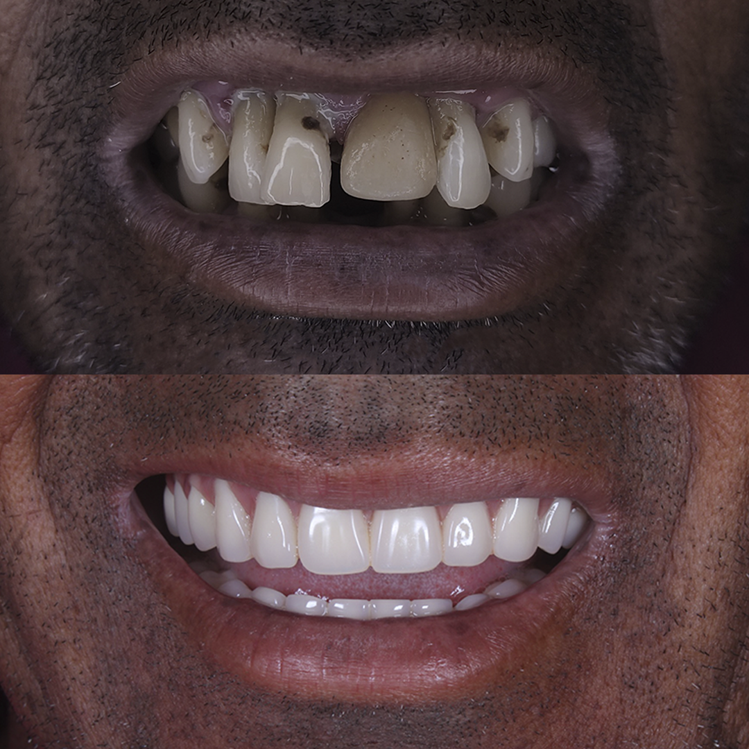 Antes e Depois - Boca-1