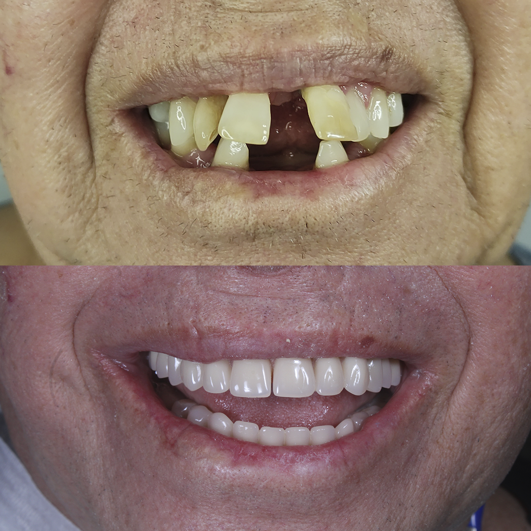 Antes e Depois - Boca