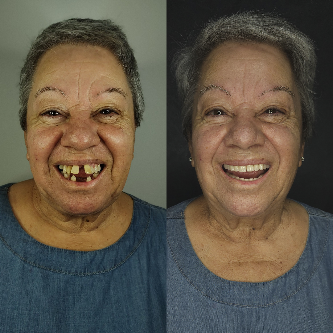 Antes e Depois - Rosto